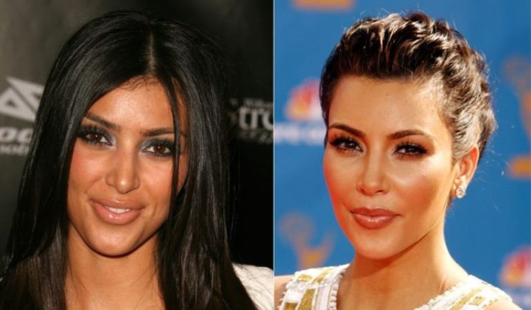 Kim Kardashian Before and After Plastic Surgery